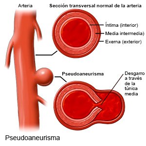 Pseudoaneurisma