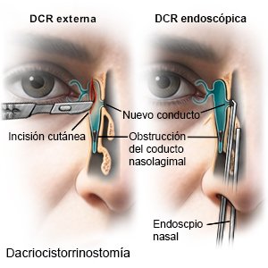 Dacriocistorrinostomía