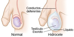 Hidrocele