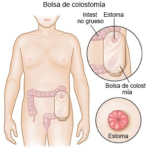 Bolsa de colostomía