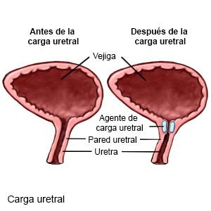 Carga uretral