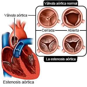 Estenosis aórtica