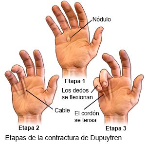 Etapas de la contractura de Dupuytren