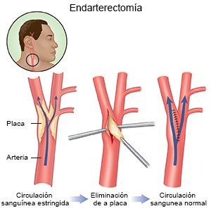 Endarterectomía