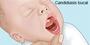 Candidiasis bucal