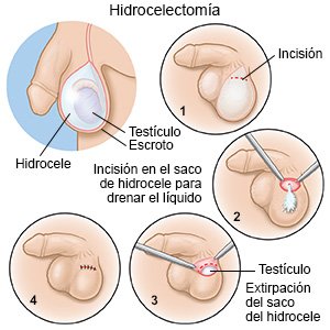 Hidrocelectomía