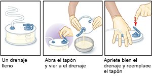 Drenaje Hemovac