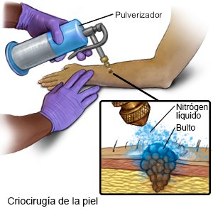 Criocirugía de la piel