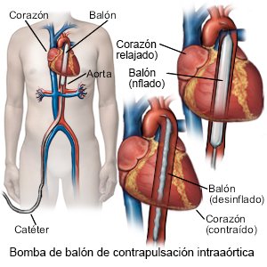 Bomba de balón de contrapulsación intraaórtica