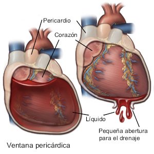 Ventana pericárdica