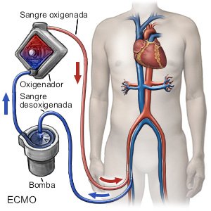 ECMO