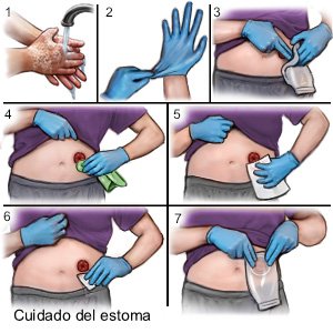 Cuidado del estoma