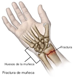 Fractura de muñeca