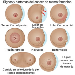 Signos y síntomas del cáncer de mama femenino