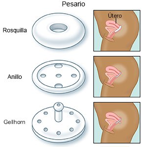 Pesario