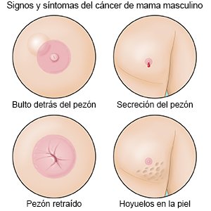 Signos y síntomas del cáncer de mama masculino