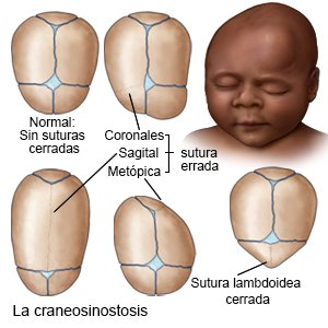 La craneosinostosis