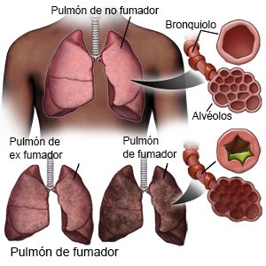 Pulmón de fumador