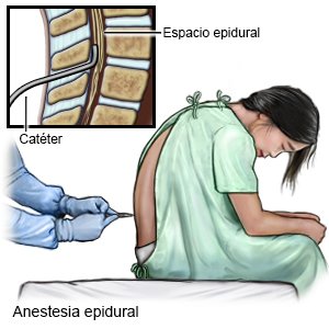 Anestesia epidural