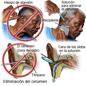 Eliminación del cerumen