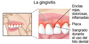 La gingivitis