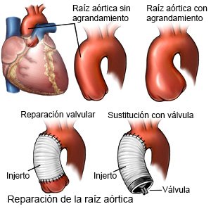 Reparación de la raíz aórtica