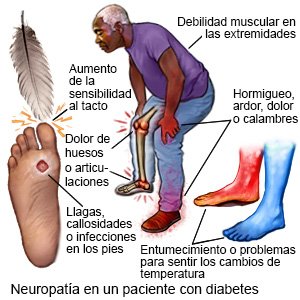 Neuropatía en la diabetes