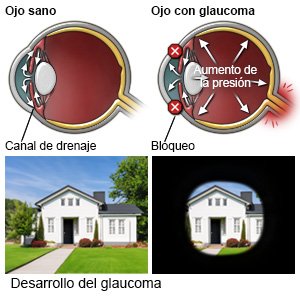 Desarrollo del glaucoma