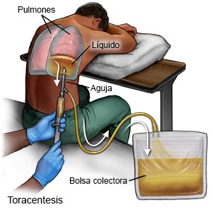 Toracentesis