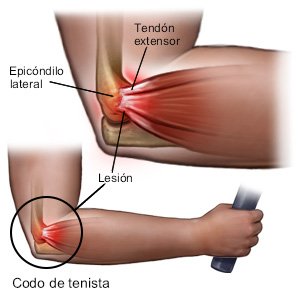 Codo de tenista