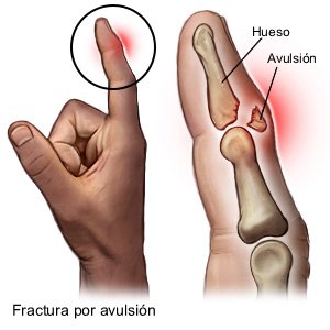 Fractura por avulsión