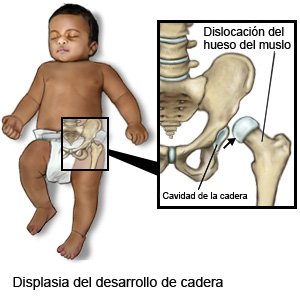 Displasia del desarrollo de cadera