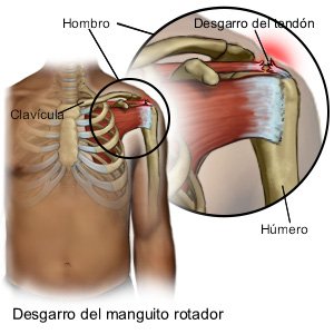 Desgarro del manguito rotador