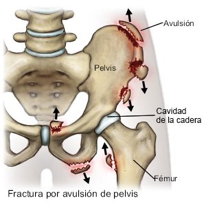 Fractura por avulsión de pelvis