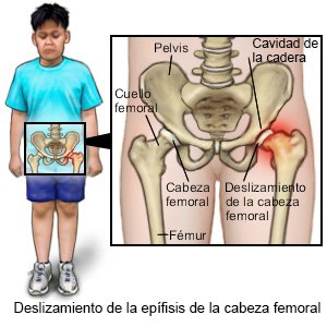 Deslizamiento de la epífisis de la cabeza femoral