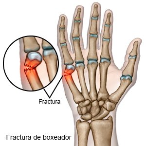 FRACTURA DE BOXEADOR