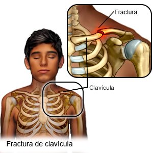 Fractura de clavícula