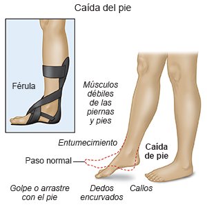 Caída del pie