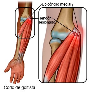 Codo de golfista