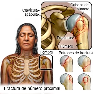 Fractura de húmero proximal