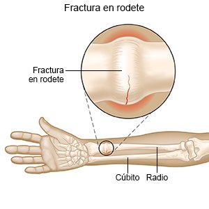 Fractura en rodete