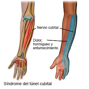 Síndrome del túnel cubital