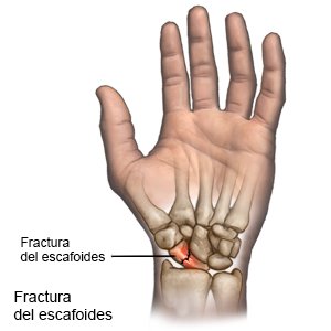 Fractura del escafoides