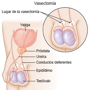 Vasectomía
