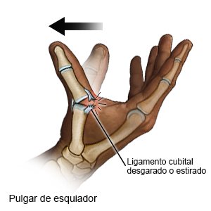 Pulgar de esquiador