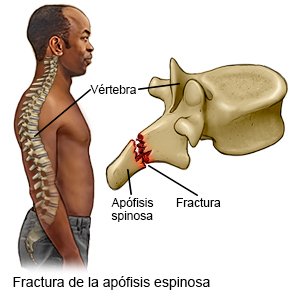 Fractura de la apófisis espinosa