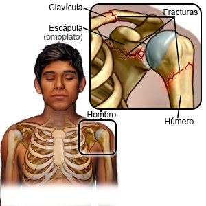 Fractura de hombro