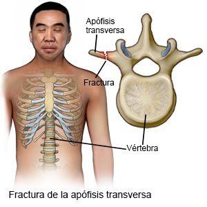 Fractura de la apófisis transversa