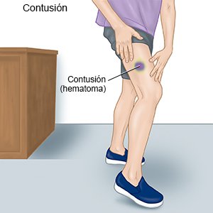 Contusión