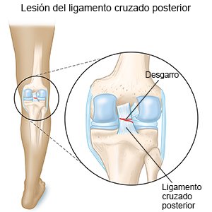 Lesión del ligamento cruzado posterior